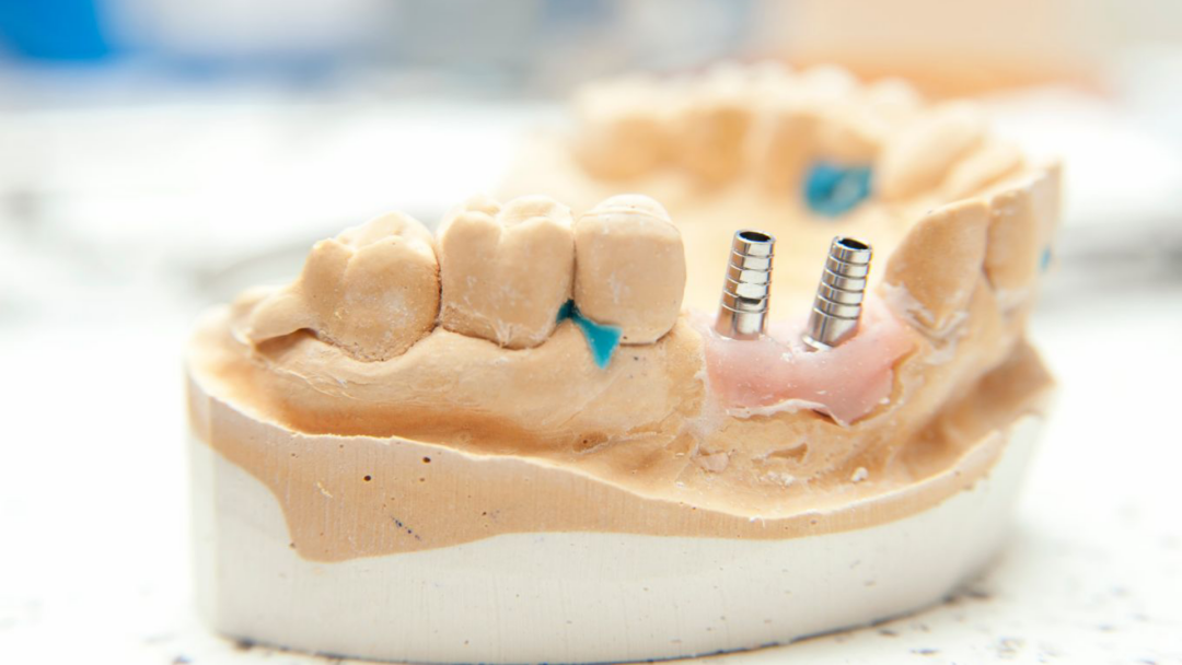 Implant Treatment