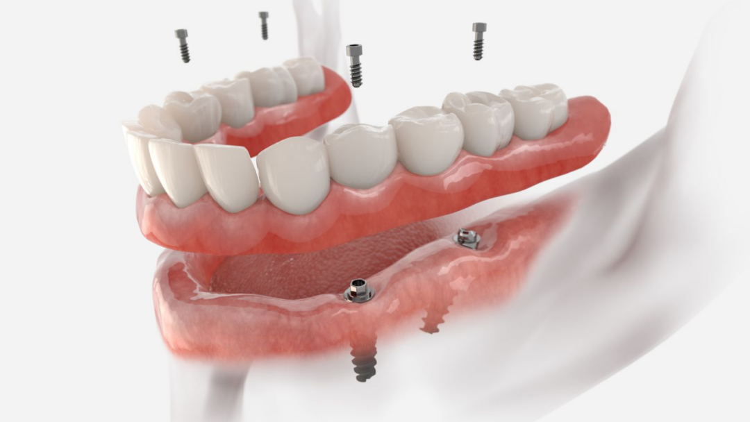 Implant Treatment