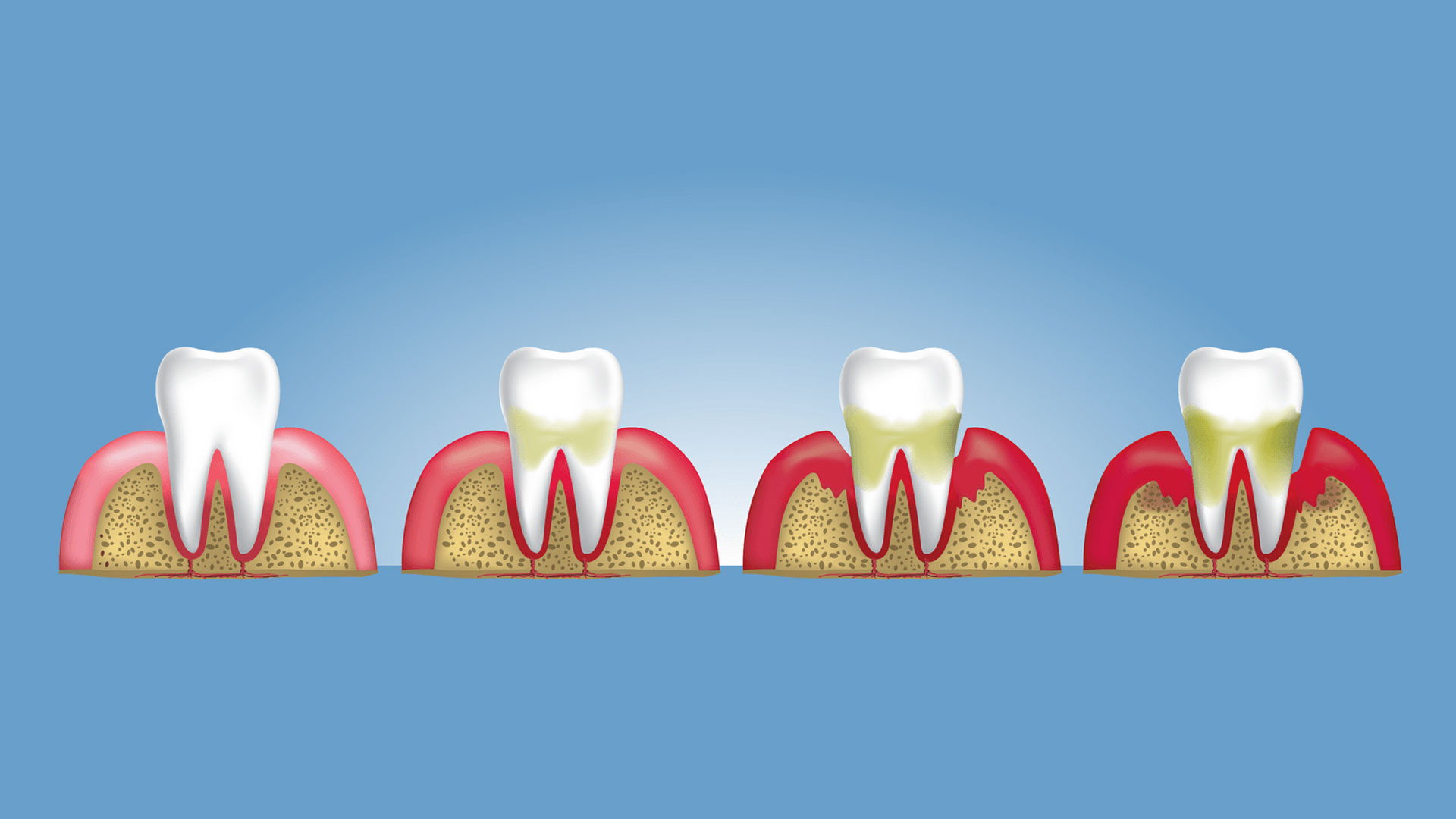 Gum Disease