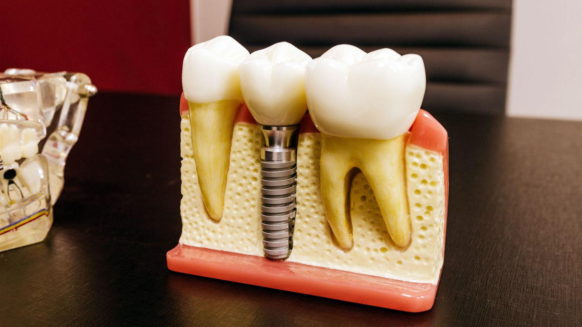 Marcas de implantes ideales