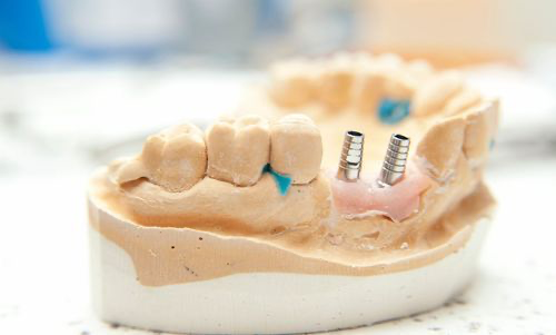 Bone Deficiency Implant Treatment