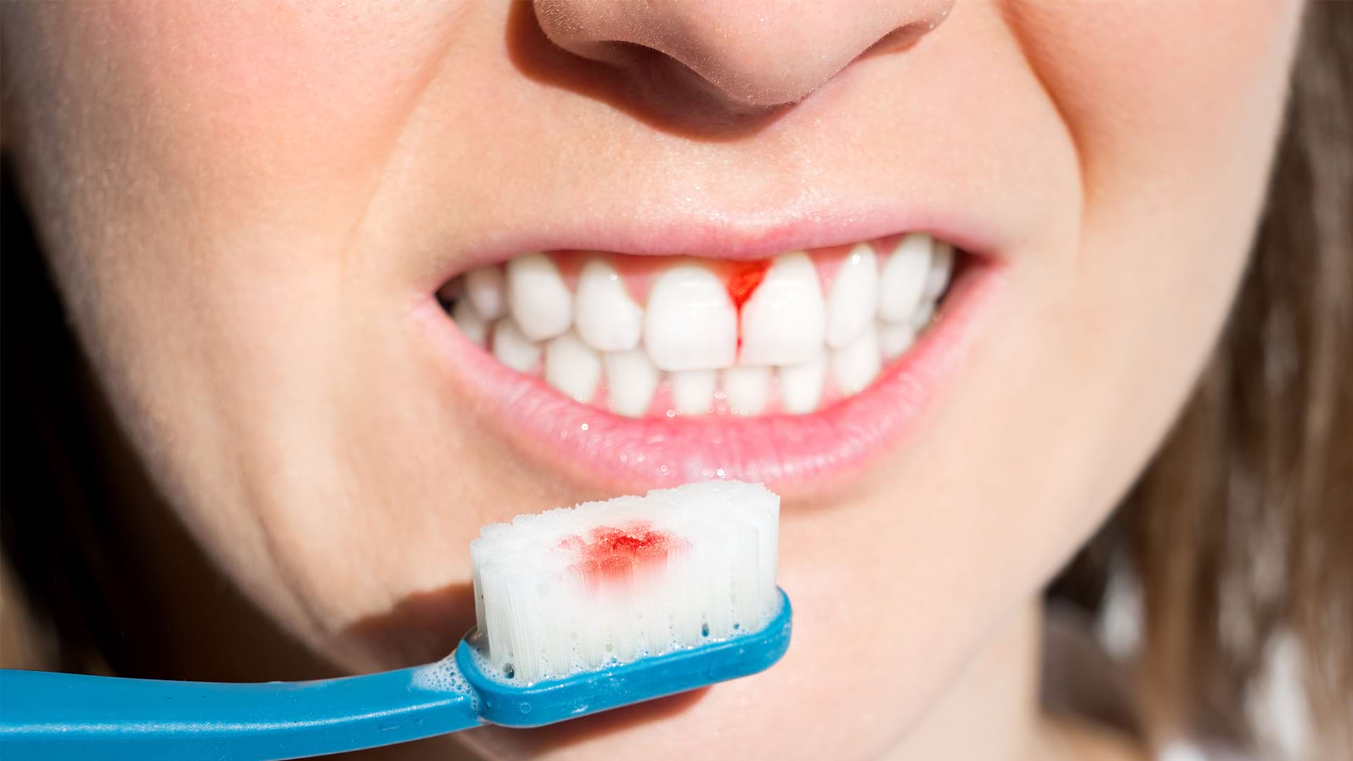 Periodontitis