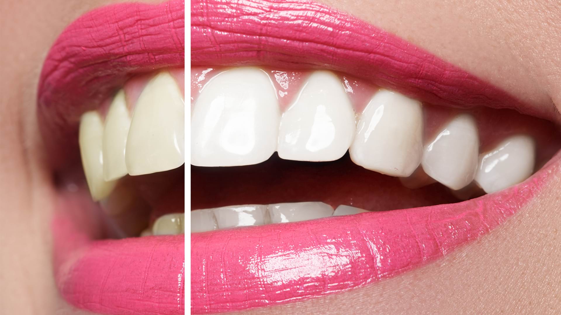 Teeth Whitening